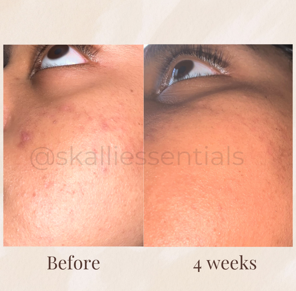 Hyperpigmentation Bundle