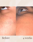 Hyperpigmentation Bundle