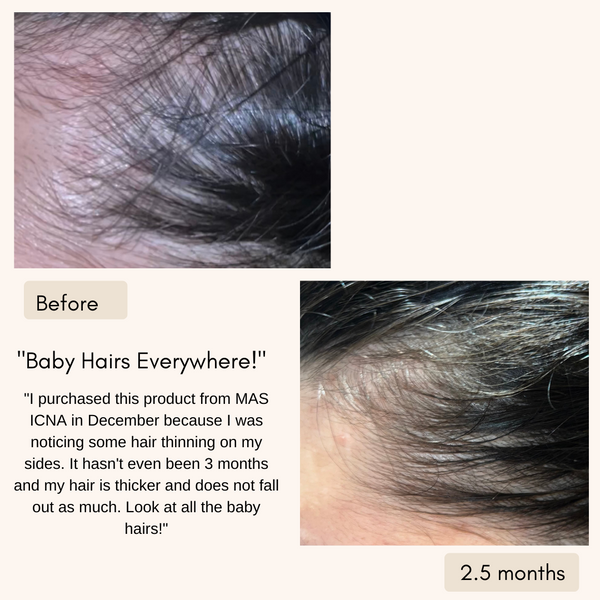 Before and After Result of our Hair scalp hair growth oil.