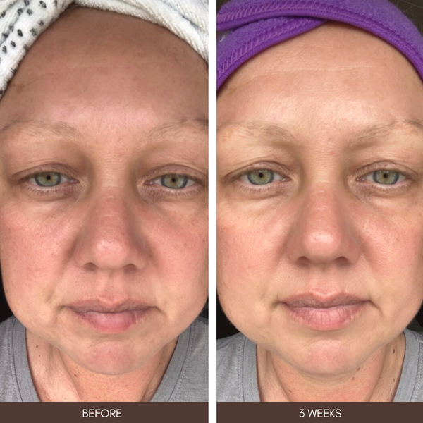Before and after 3-week skin results using Skalli Essentials Moroccan Prickly Pear Seed Oil, showing improved smoothness, hydration, and reduced dullness.